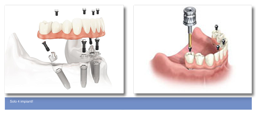banner L ESPERIENZA E TECNOLOGIE ALL AVANGUARDIA Implantologia Dentale su 4 impianti 1 s